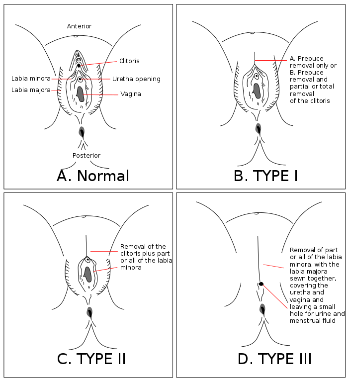 Female Genital Mutilation